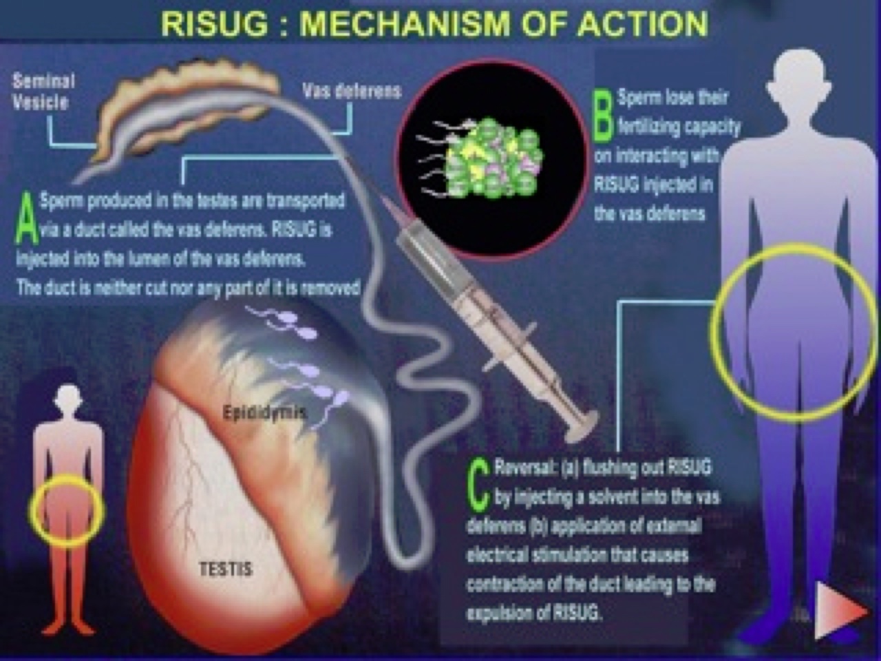 RISUG procedure